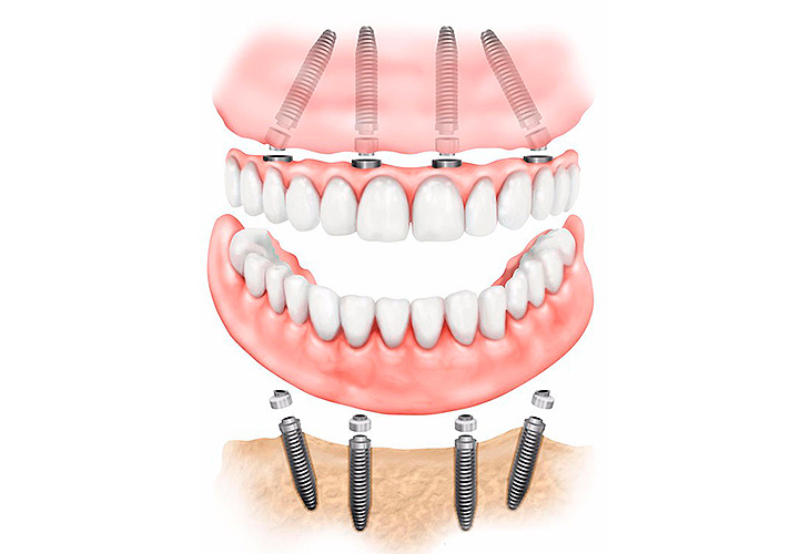 Имплантация зубов All-on-4
